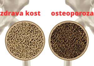 osteoporoza in zdrava kost ALKIVITA Zapper dr. Clark